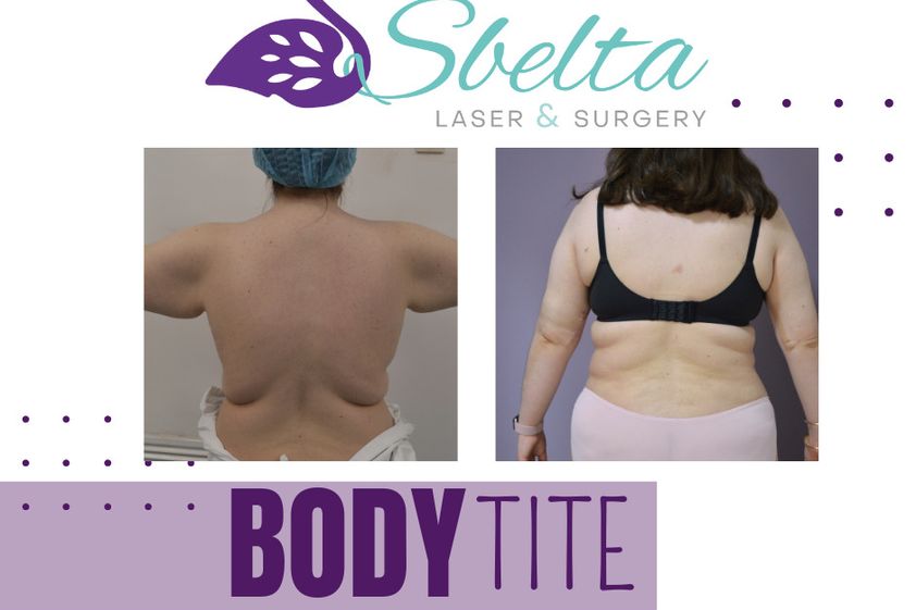 Lipoescultura antes y después - 870625