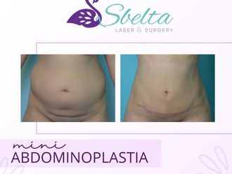 Abdominoplastia antes y después - 870626