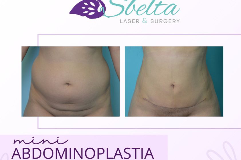 Abdominoplastia antes y después - 870626