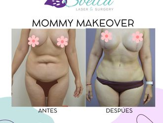 Mommy makeover antes y después - 870627