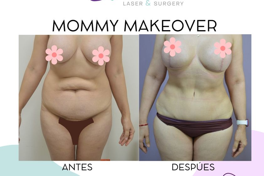 Mommy makeover antes y después - 870627
