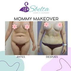 Mommy makeover - Dra. Jessica Ramírez Cadena