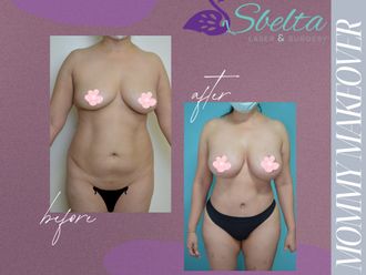 Mommy makeover antes y después - 875177