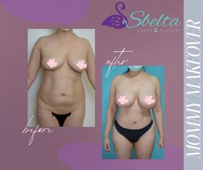 Mommy Makeover - Dra. Jessica Ramírez Cadena