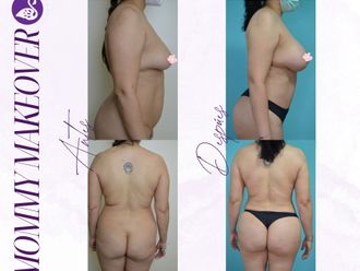 Mommy makeover antes y después - 875178