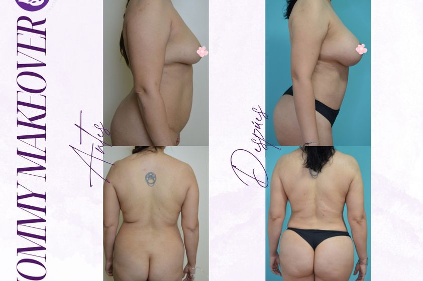 Mommy makeover antes y después - 875178