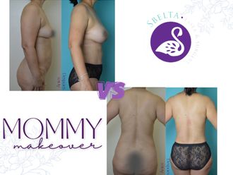Mommy makeover antes y después - 875179
