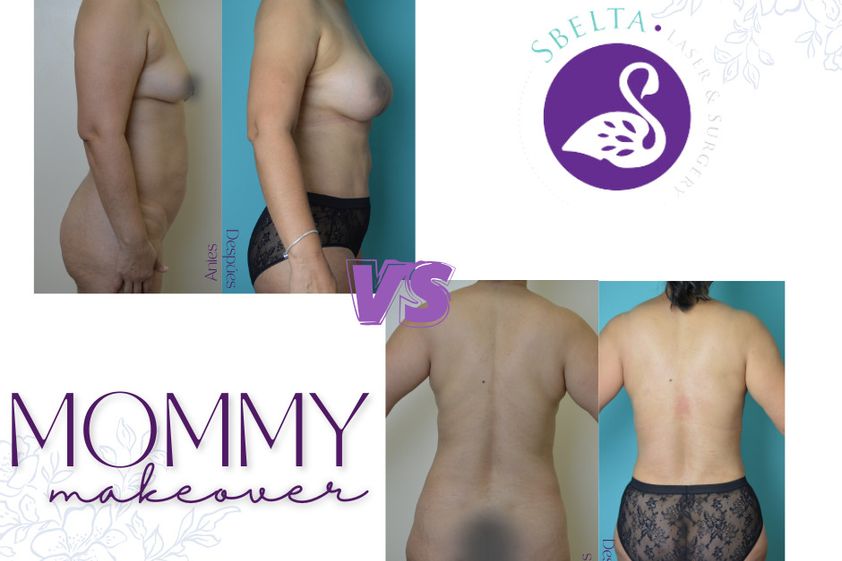 Mommy makeover antes y después - 875179