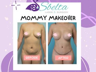 Mommy makeover antes y después - 875255