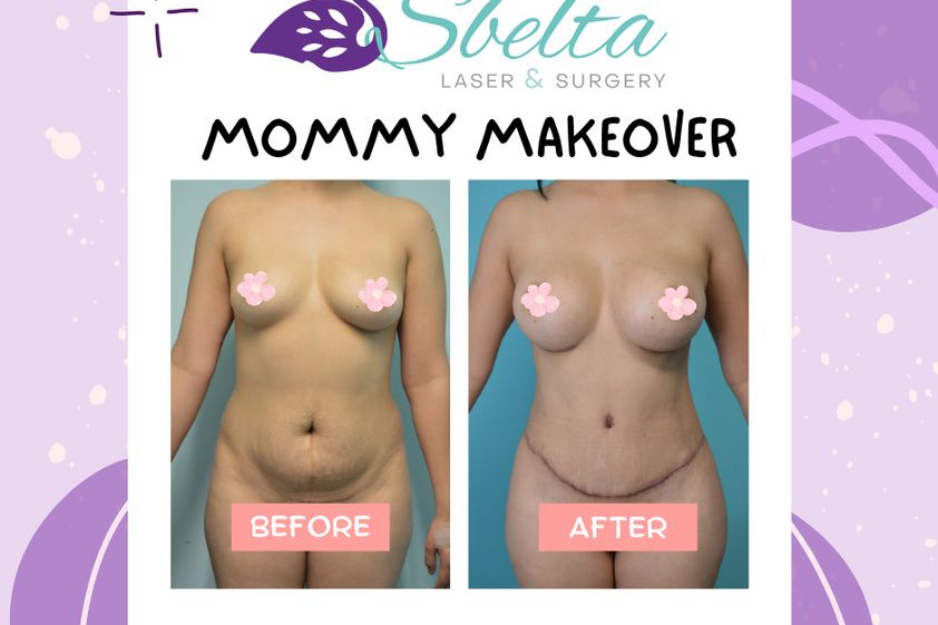 Mommy makeover antes y después - 875255