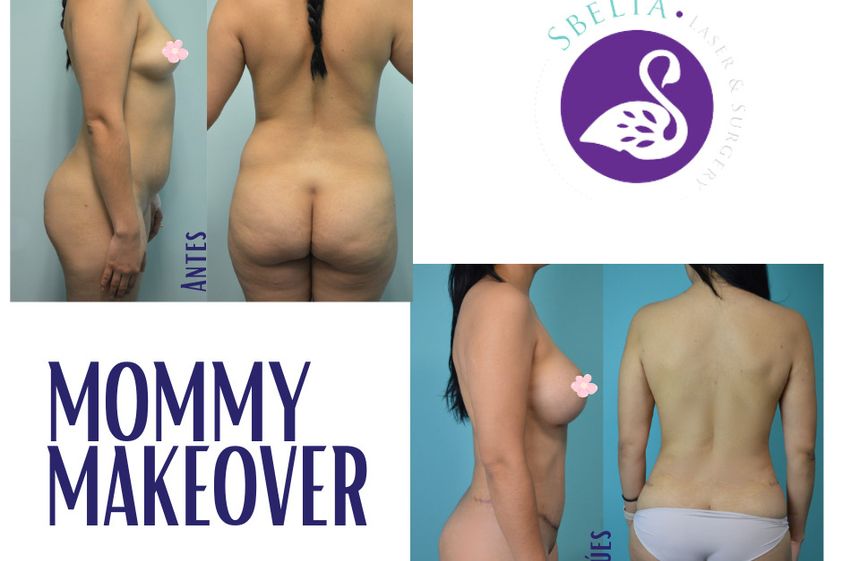 Mommy makeover antes y después - 875256