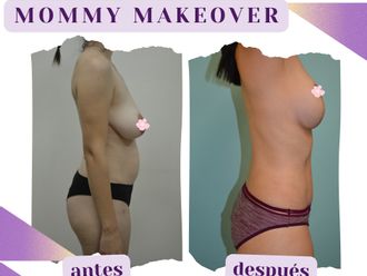 Mommy makeover antes y después - 875437