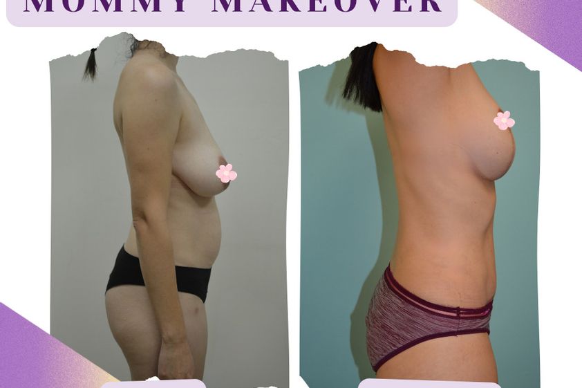 Mommy makeover antes y después - 875437
