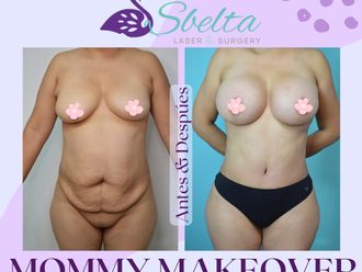 Mommy makeover antes y después - 875438