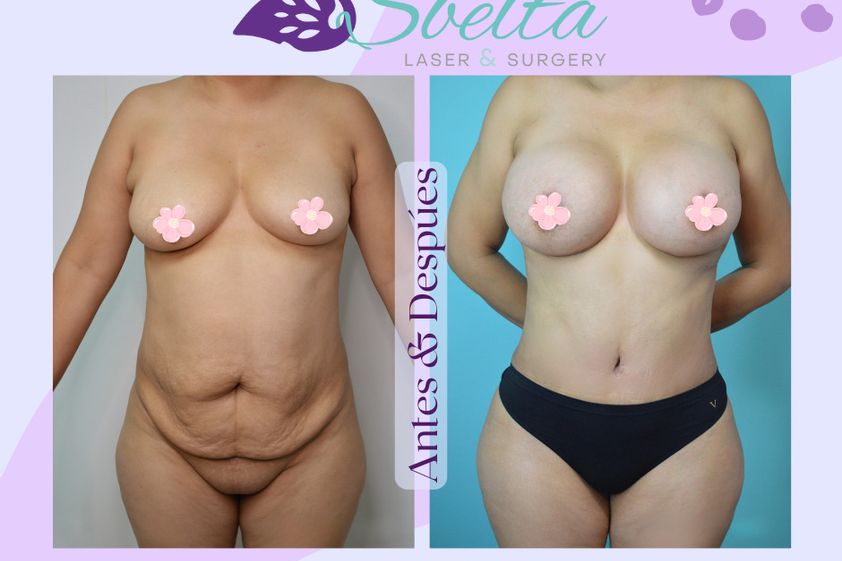 Mommy makeover antes y después - 875438