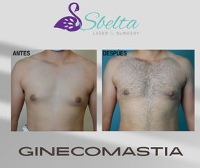Ginecomastia - Dra. Jessica Ramírez Cadena