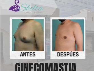 Cirugía ginecomastia antes y después - 875543