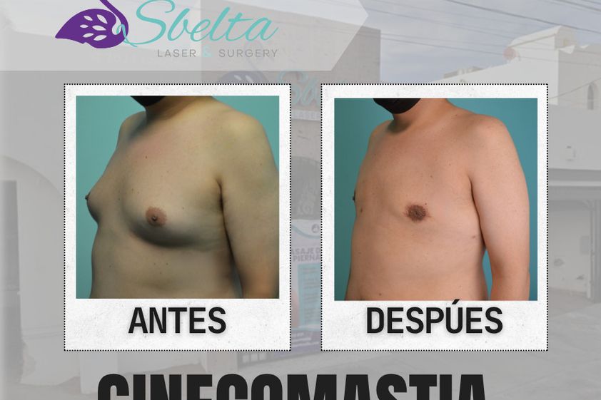 Cirugía ginecomastia antes y después - 875543