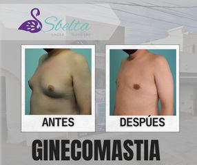 Ginecomastia - Dra. Jessica Ramírez Cadena