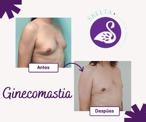 Ginecomastia  - Dra. Jessica Ramírez Cadena