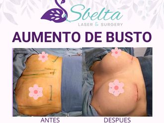 Aumento de busto antes y después - 876692