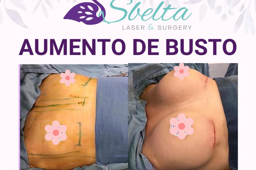 Aumento de busto antes y después - 876692
