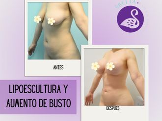 Lipoescultura antes y después - 876694