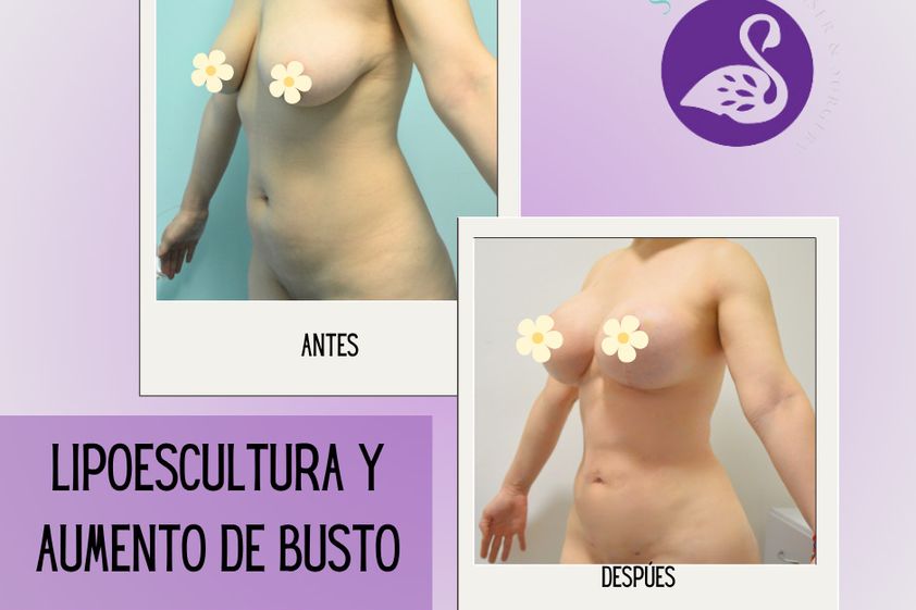 Lipoescultura antes y después - 876694