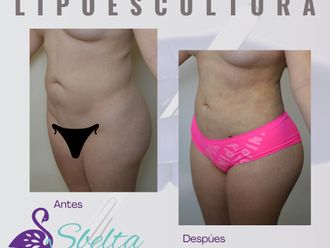 Lipoescultura antes y después - 877010