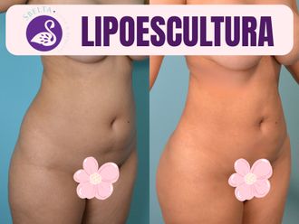 Lipoescultura antes y después - 877011
