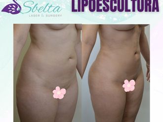 Lipoescultura antes y después - 877117