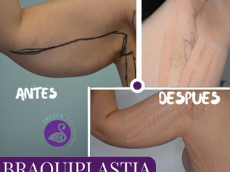 Braquioplastia antes y después - 877379