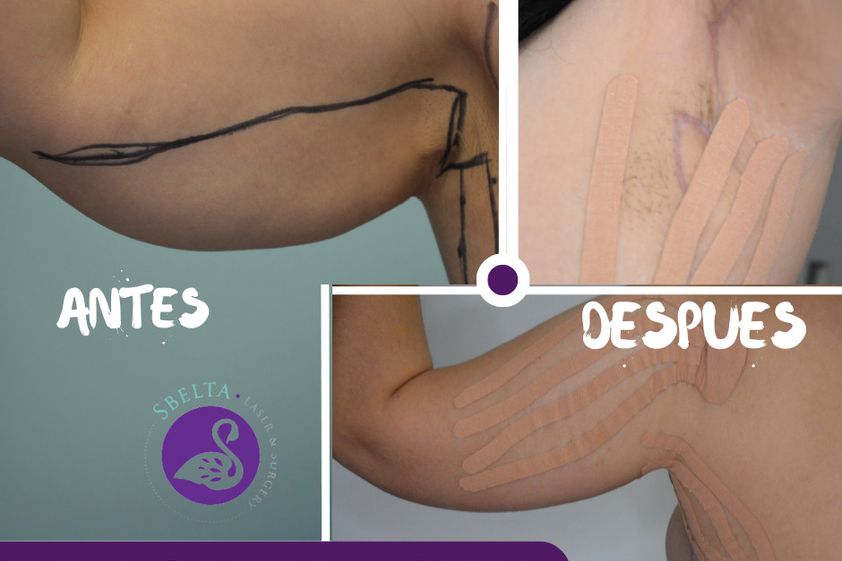 Braquioplastia antes y después - 877379