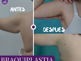 Braquioplastia antes y después - 877380