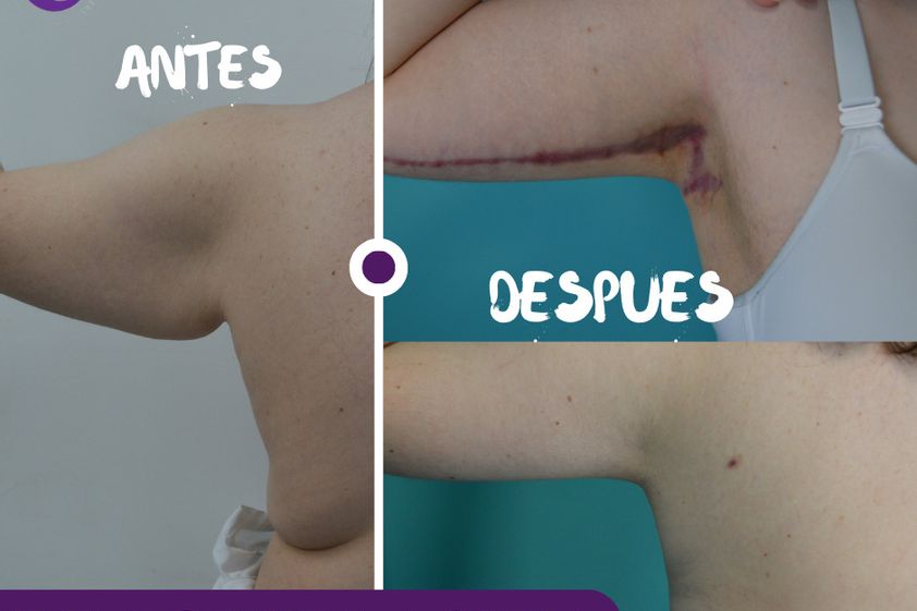 Braquioplastia antes y después - 877380