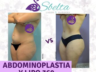Abdominoplastia antes y después - 879114