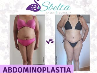 Abdominoplastia antes y después - 879115