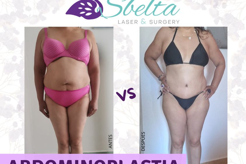 Abdominoplastia antes y después - 879115
