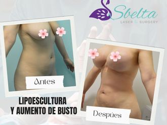 Aumento de busto antes y después - 879959