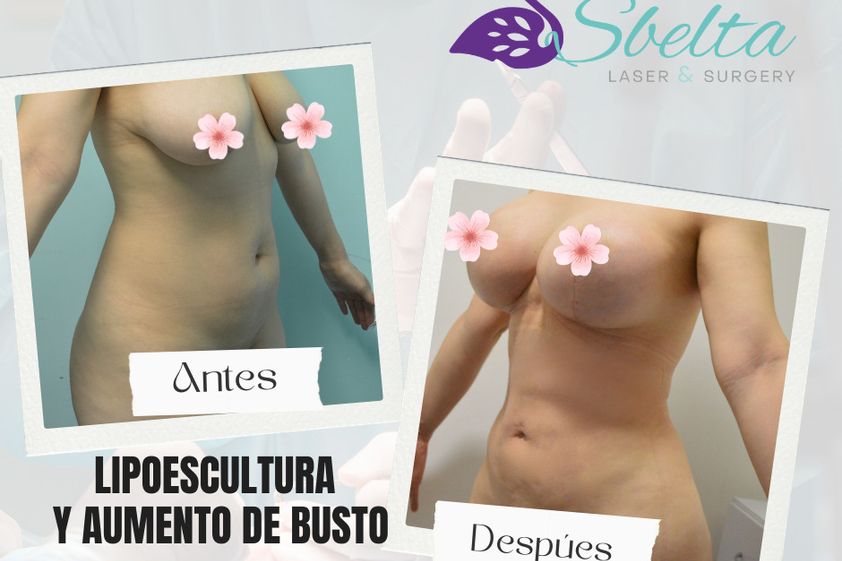 Aumento de busto antes y después - 879959
