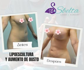Implantes de mamam y lipoescultura