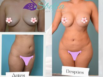 Lipoescultura antes y después - 879960