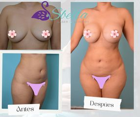lipoescultura y aumento de busto