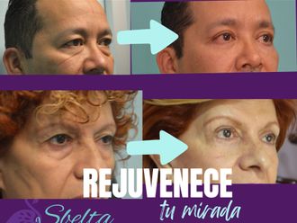 Blefaroplastia antes y después - 879962