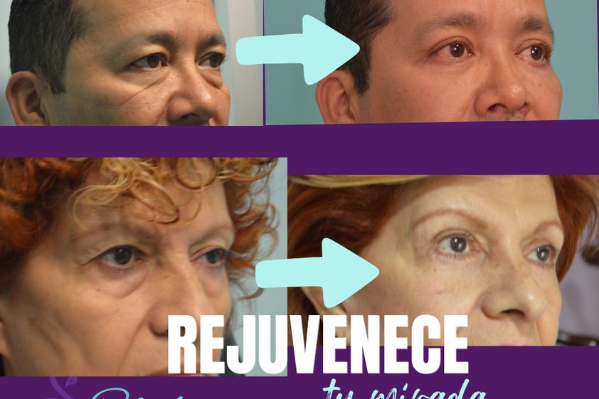 Blefaroplastia antes y después - 879962