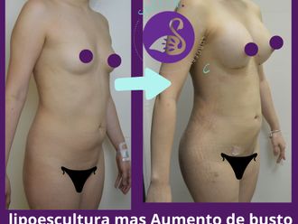 Lipoescultura antes y después - 880202