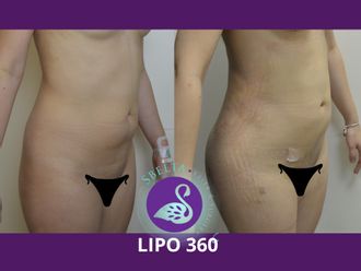 Lipoescultura antes y después - 880203