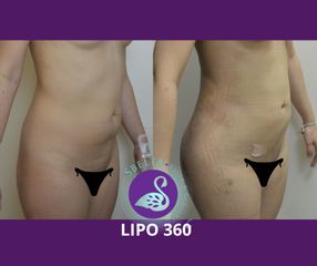 Lipoescultura - Dra. Jessica Ramírez Cadena