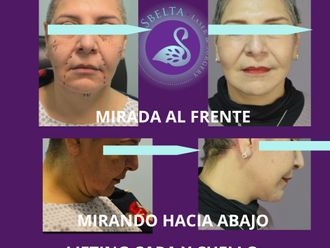 Rejuvenecimiento facial antes y después - 880204