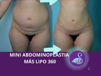 Abdominoplastia antes y después - 880205